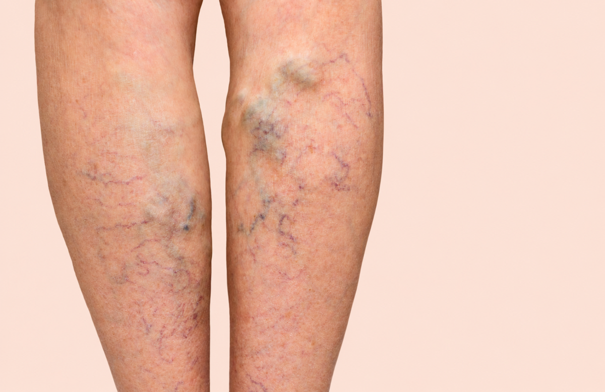 Varices visibles en las piernas